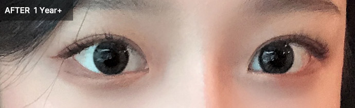 eyelid natural 02 after