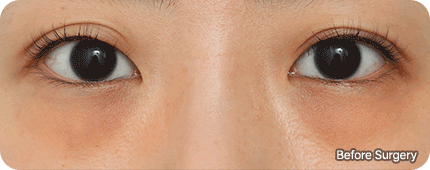 Under Eye Fat Reposition 15 fat relocationgif main 1