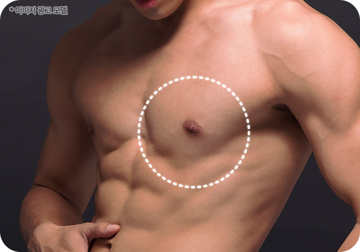 male breast single mo