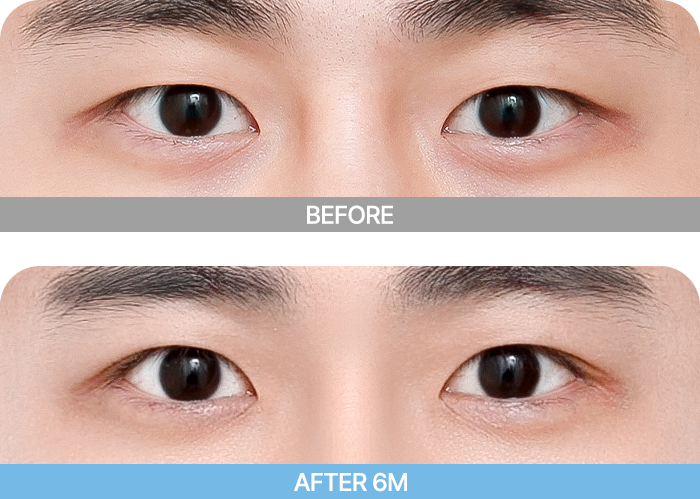 male eye two mo