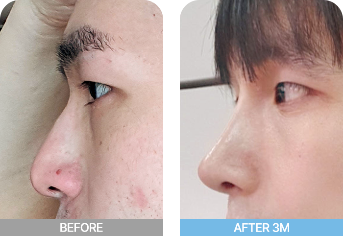 male nose two mo