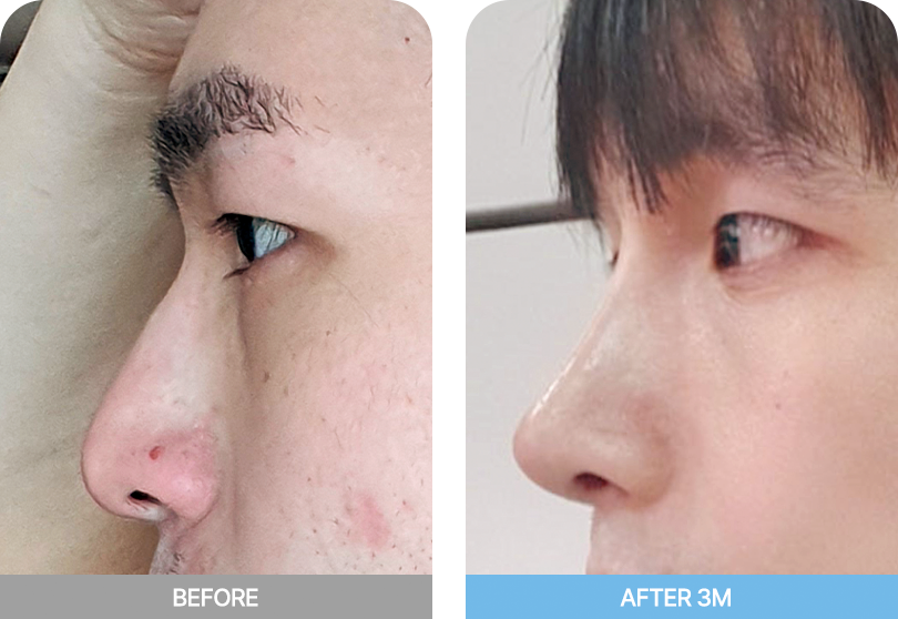 male nose two pc