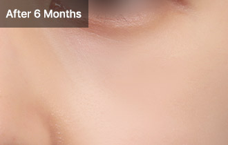 Under Eye Fat Reposition 47 province viewtist 2