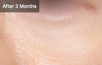 Under Eye Fat Reposition 51 province viewtist 4