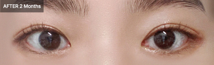 re eyelid 01 after pc