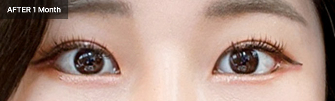 re eyelid 02 after pc