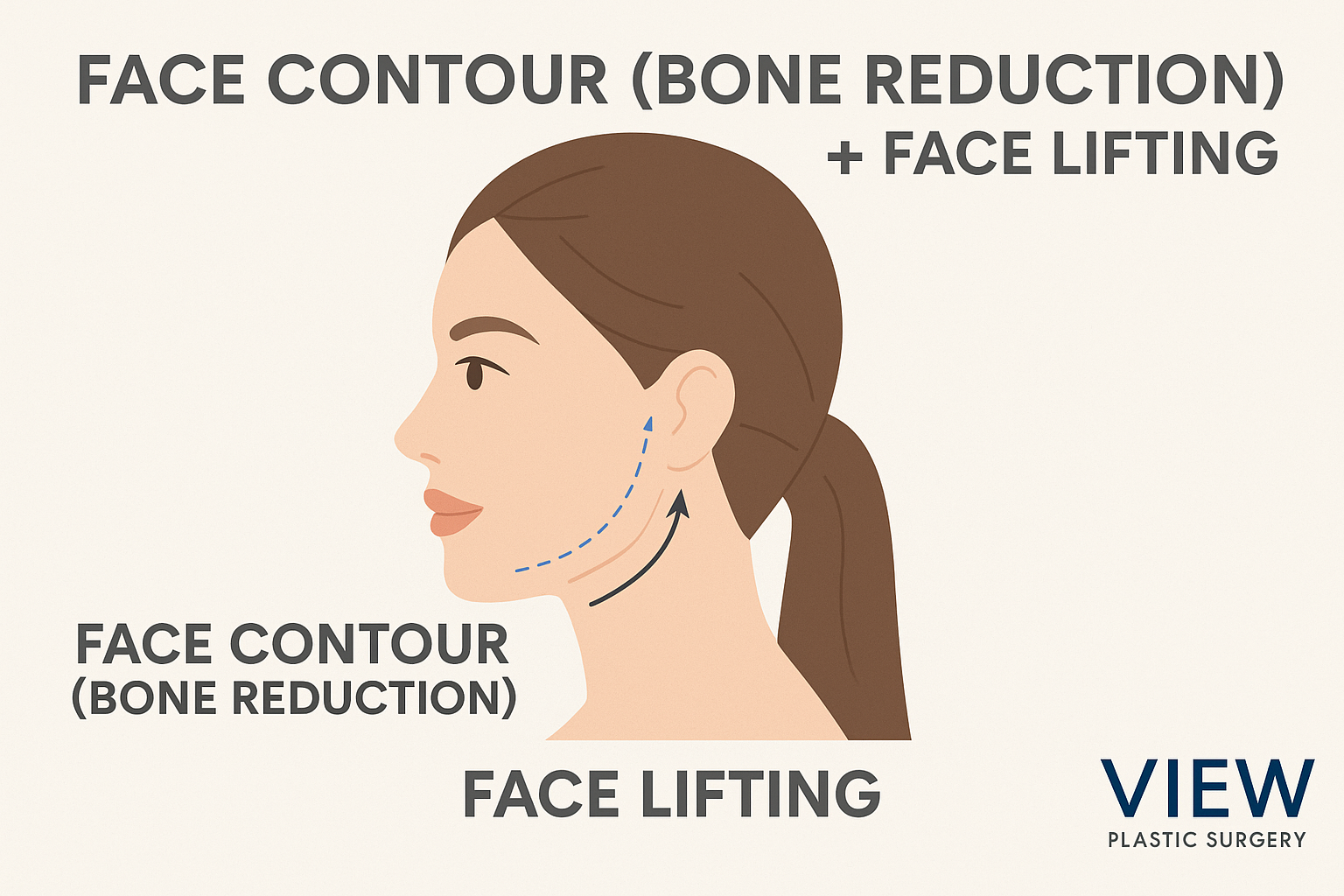 Educational infographic showing combination facial contouring (bone reduction) and face lifting procedures at VIEW Plastic Surgery Korea, illustrating jawline contouring and upward lifting for facial rejuvenation.