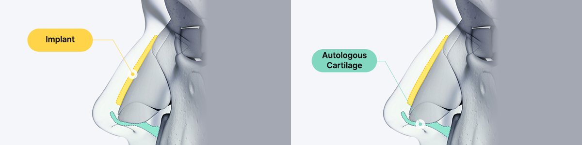 Celebrity rhinoplasty in Korea using 3D CT evaluation