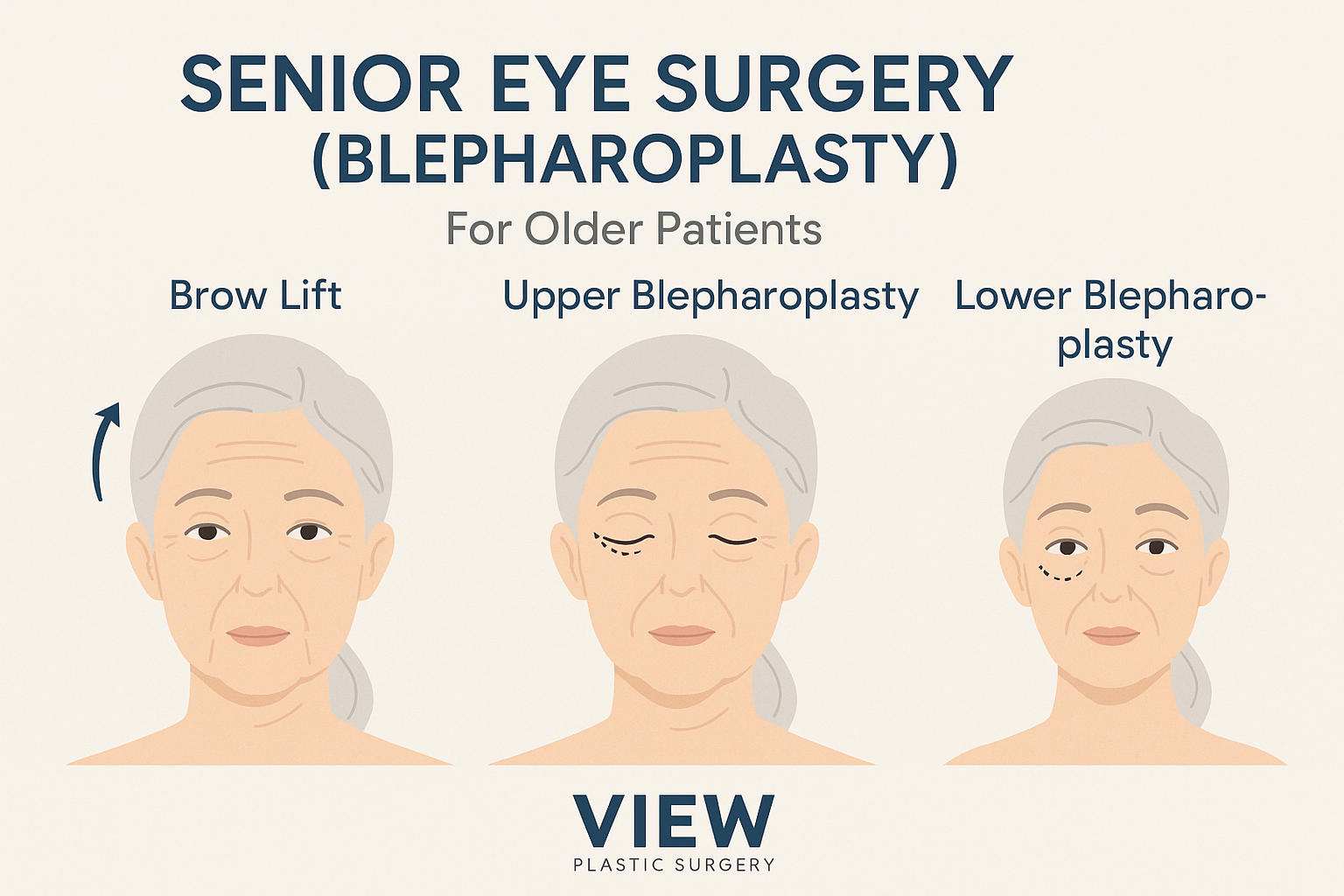 Educational medical infographic showing senior eye surgery procedures — brow lift, upper blepharoplasty, and lower blepharoplasty — for older patients at View Plastic Surgery Korea.