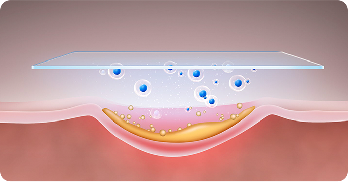 Stem Cell Scar Therapy in Korea for regeneration of damaged skin cells and collagen to improve scars and pigmentation