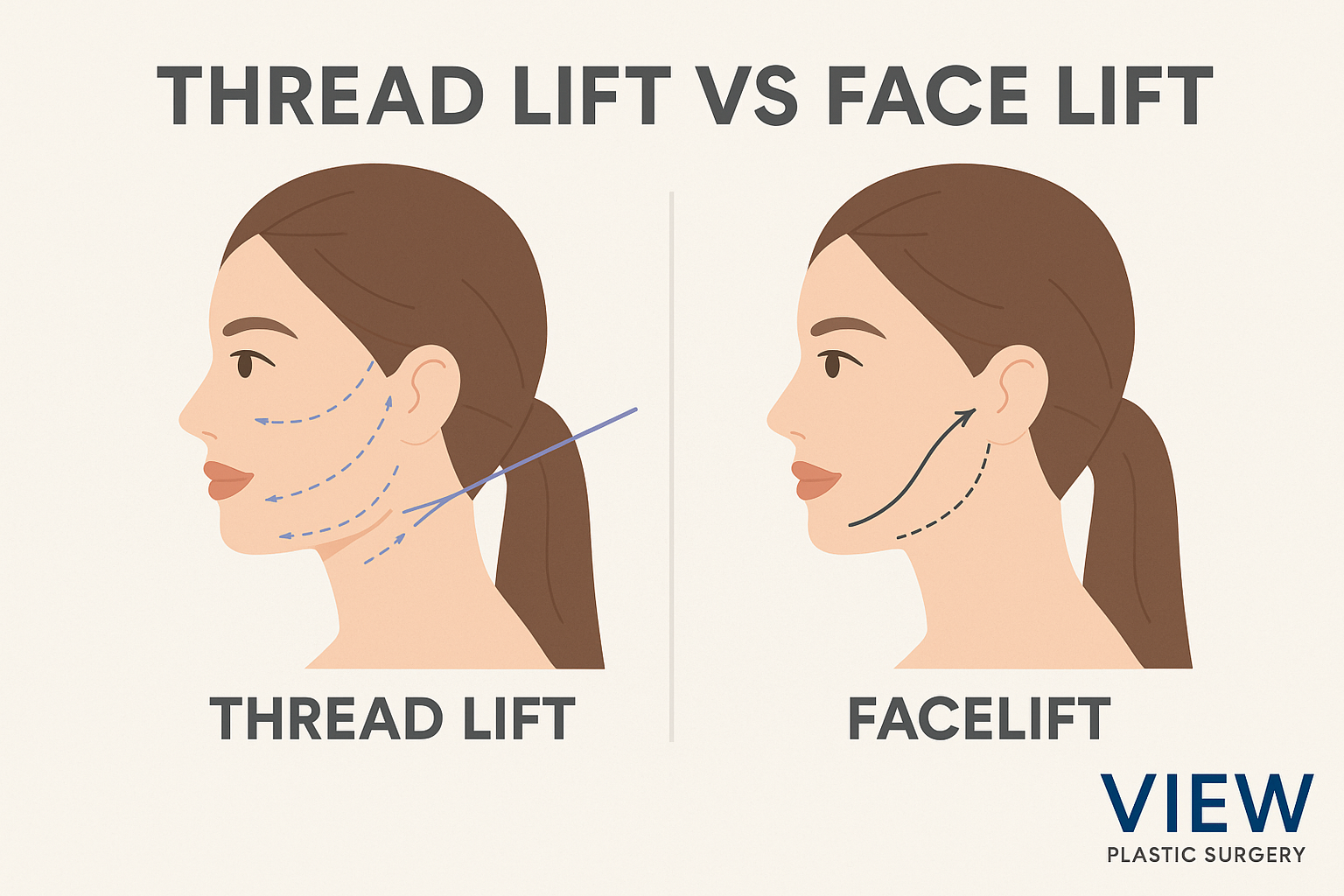 Educational infographic comparing Thread Lift and Facelift procedures at VIEW Plastic Surgery Korea, illustrating the difference between minimally invasive thread lifting and surgical facelift techniques for facial rejuvenation.