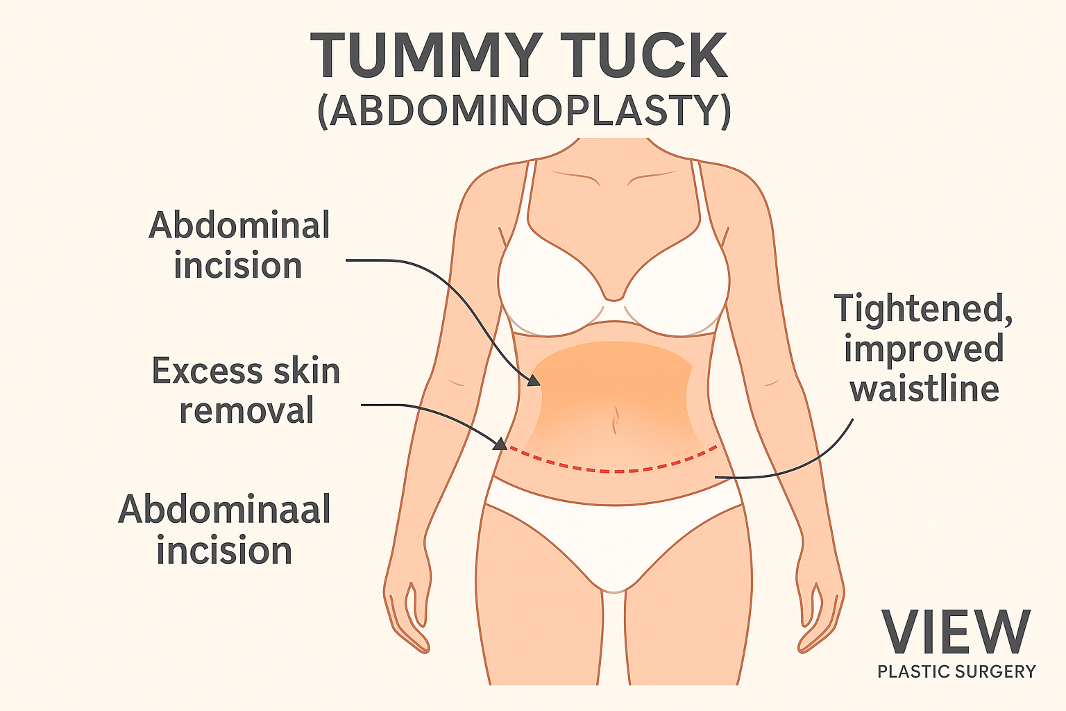 Educational infographic showing tummy tuck (abdominoplasty) surgery at VIEW Plastic Surgery Korea, illustrating abdominal incision line, excess skin removal, and tightening of abdominal contour for a flatter, firmer waistline.