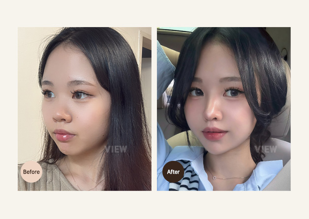[Rhinoplasty] Lim Sohyeon | Plastic Surgery Korea