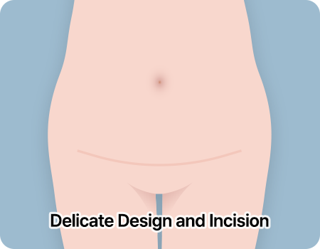 abdominoplasty step01 design incision mo