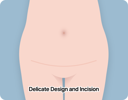 abdominoplasty step01 design incision
