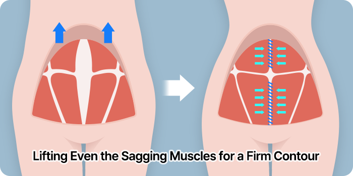 abdominoplasty step02 skin muscle mo