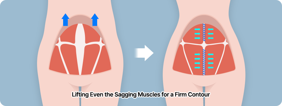 abdominoplasty step02 skin muscle