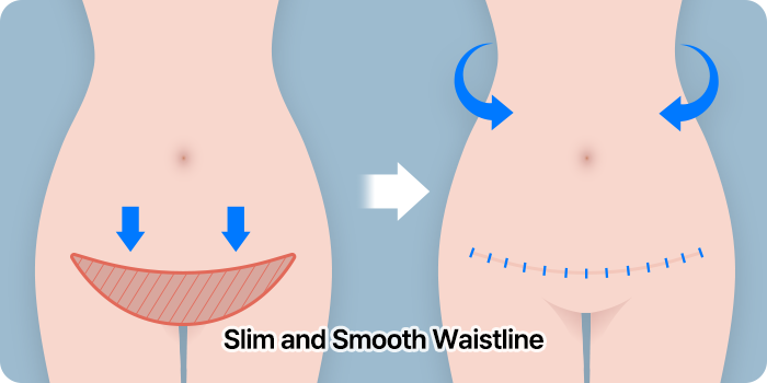 abdominoplasty step03 suturing mo