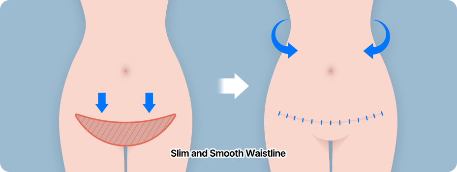 abdominoplasty step03 suturing