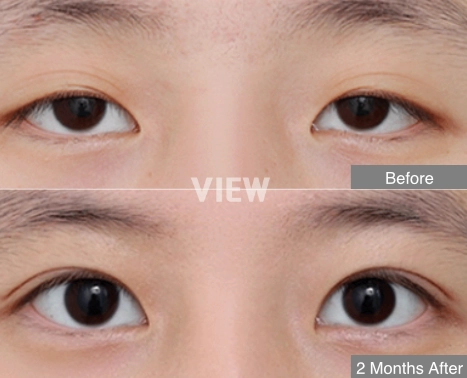 benefits-of-ptosis-correction