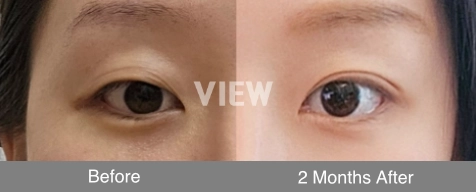 double eyelid combo non incisional method