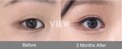 double eyelid natural adhesion method