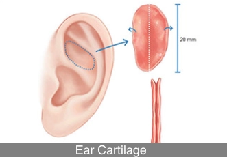 ear cartilage rhinoplasty graft