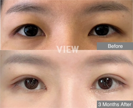 Medical illustration explaining epicanthoplasty, a procedure that modifies the inner corner of the eye to reduce epicanthal folds and create a clearer medial canthal contour