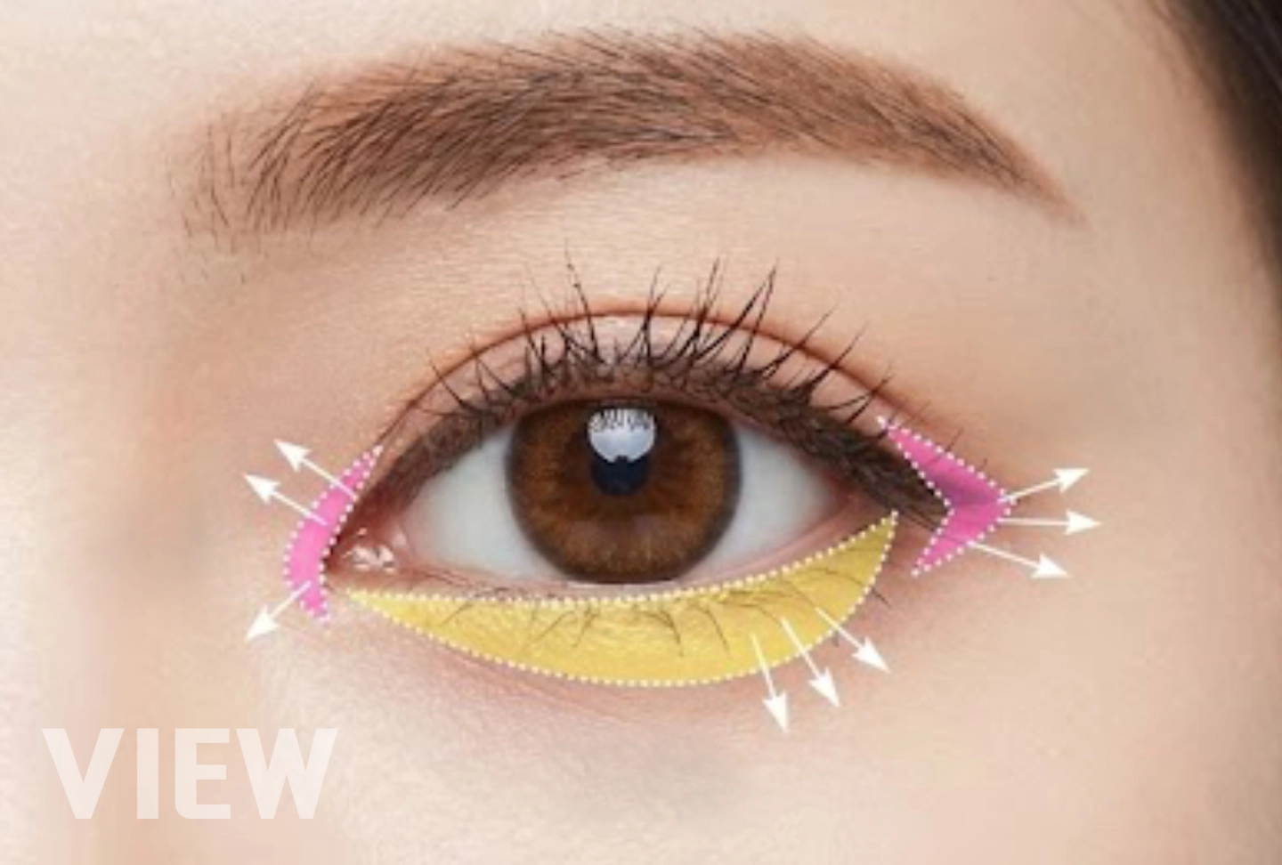 Medical illustration comparing epicanthoplasty, lateral canthoplasty, and lower canthoplasty, showing how inner, outer, and lower eye corner procedures affect eye shape and width.