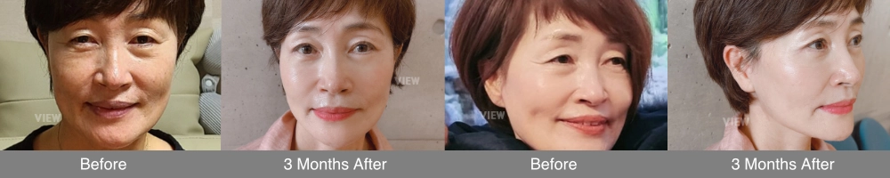 facial fat grafting before after volume restoration