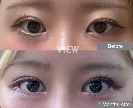 lower canthoplasty lower eyelid eye surgery