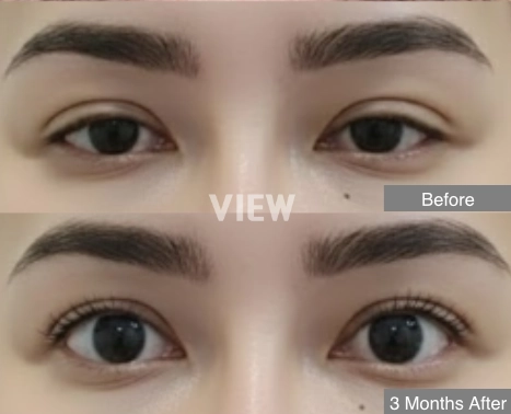 middle eastern eye surgery before after