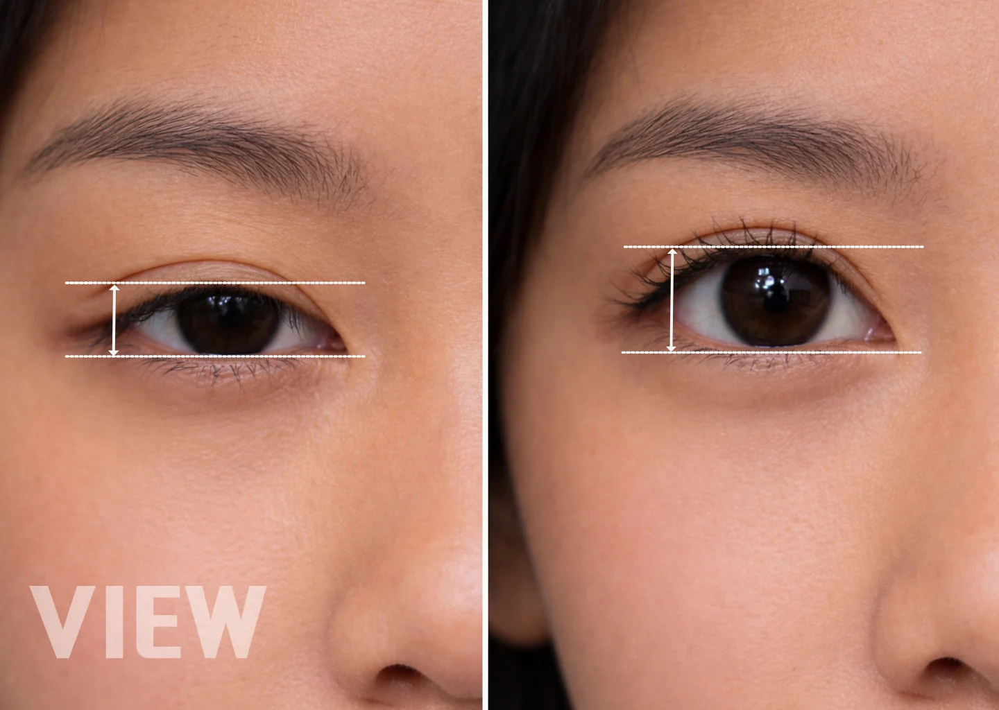 Before and after comparison of Ptosis Correction showing improved upper eyelid height and increased eye opening ratio