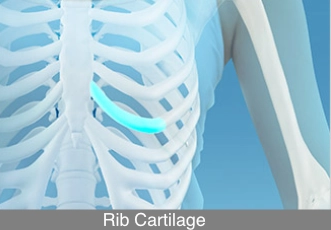Illustration of rib cartilage used as a structural graft material in rhinoplasty, commonly selected for strong support in complex or revision nose surgery