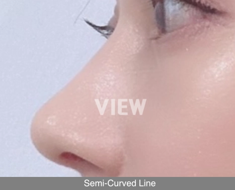 Semi-curved nose line example in Korean rhinoplasty balancing straight and curved nasal contours