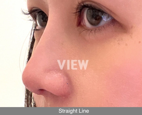 Straight nose line example in Korean rhinoplasty showing a smooth bridge from forehead to nasal tip