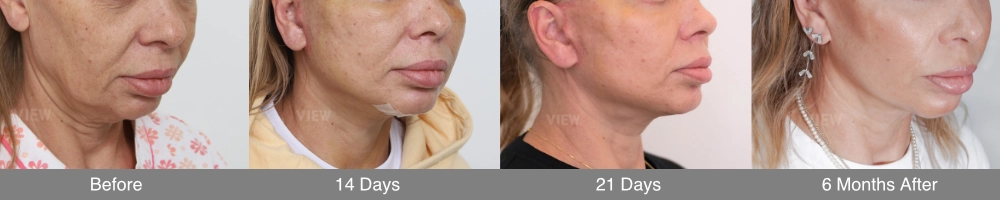 Before-and-after comparison of submentoplasty and platysmaplasty showing improved neck contour and a sharper jawline by tightening neck muscles and reducing submental fullness