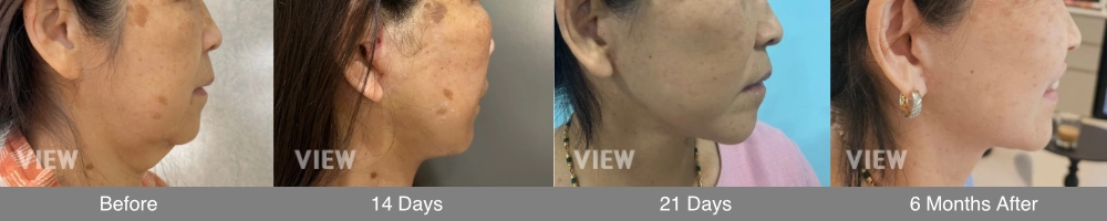 Before-and-after comparison of submentoplasty and platysmaplasty showing improved neck contour and a sharper jawline by tightening neck muscles and reducing submental fullness