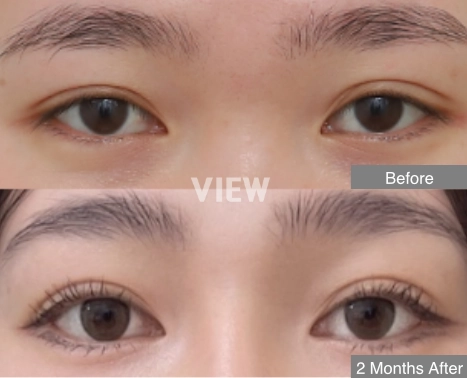 Before-and-after comparison of double eyelid surgery in Thai and Southeast Asian patients, showing improved eyelid definition and eye-opening balance based on thicker skin and soft tissue structure