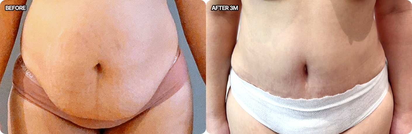 view abdominoplasty before after pc
