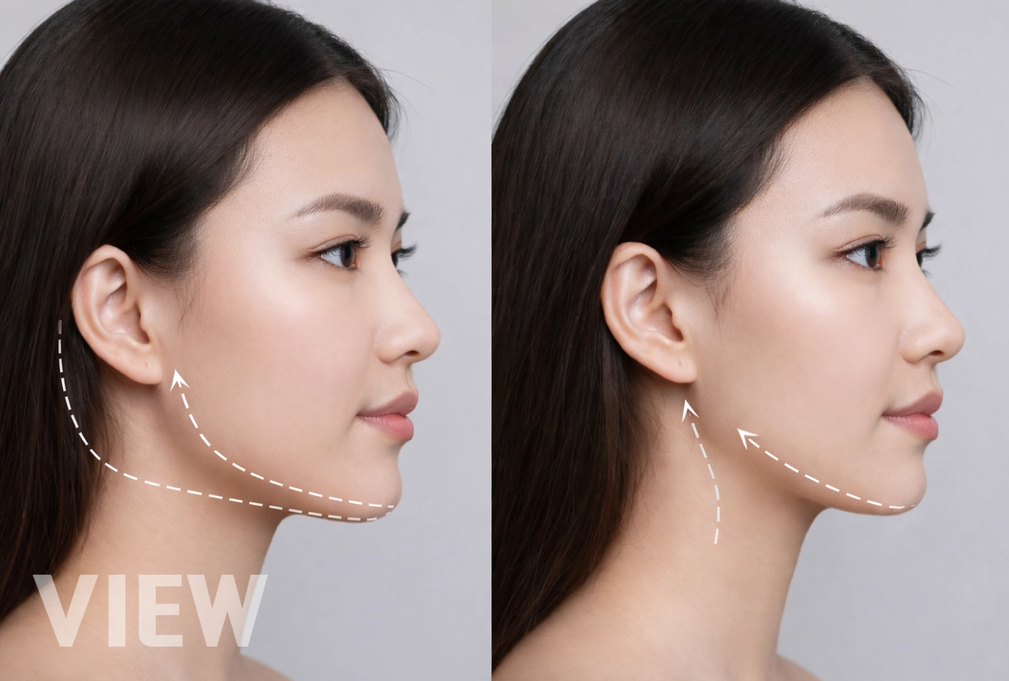 Thumbnail image introducing how facial contouring surgery works, illustrating facial structure analysis and the principles behind jaw and facial bone contouring