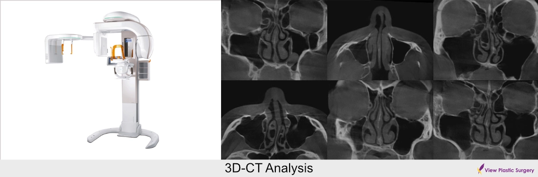 3D CT analysis for functional rhinoplasty evaluating nasal septum and airway structure in Korea