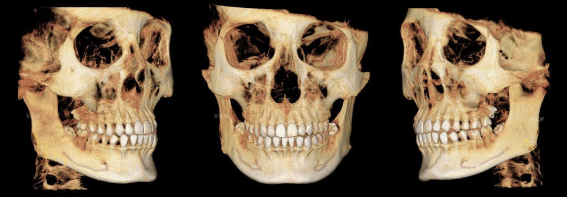 3d ct skull reconstruction orthognathic surgery analysis 1