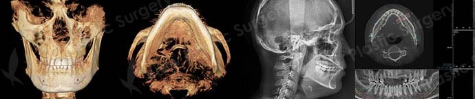 Preoperative structural analysis image demonstrating evaluation of facial symmetry, bone position, and proportion before facial contouring surgery