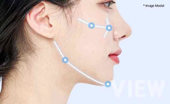 Diagram showing why the direction and position of bone movement are more important than the amount of bone reduction in facial contouring surgery