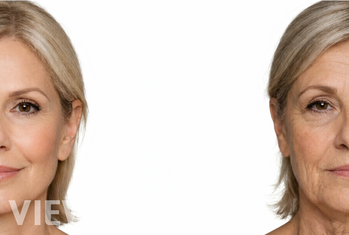 Thumbnail image introducing advanced anti-aging surgery for patients in their 60s, highlighting comprehensive facial and neck rejuvenation procedures to address age-related changes