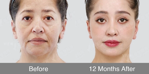 Before and after comparison showing long-term facial rejuvenation results twelve months after anti-aging surgery, with more even skin tone and balanced facial appearance.