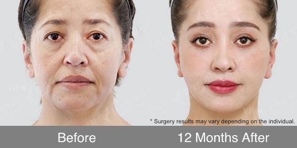 anti aging surgery before after 12 months long term result 2