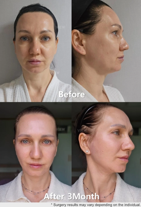 Before and after comparison showing facial rejuvenation three months after anti-aging surgery, with improved skin firmness and more balanced facial contours in front and side views.