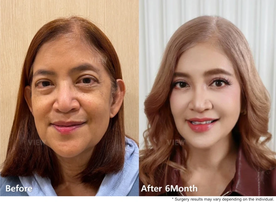 Before and after comparison showing facial rejuvenation six months after anti-aging surgery, with improved skin tone and a more balanced overall facial appearance.